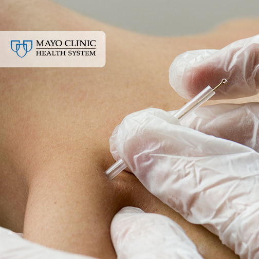 dry_needling_504x504