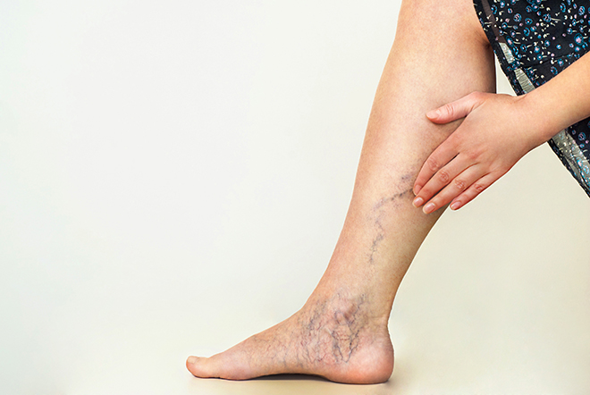 woman-touching-varicose-veins-on-leg