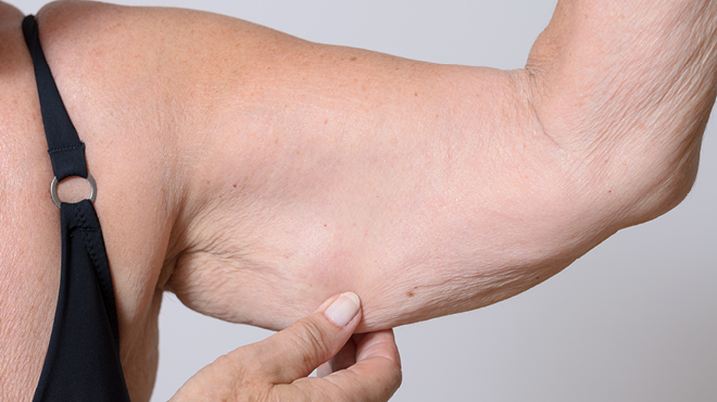 因老化皮肤松弛的手臂