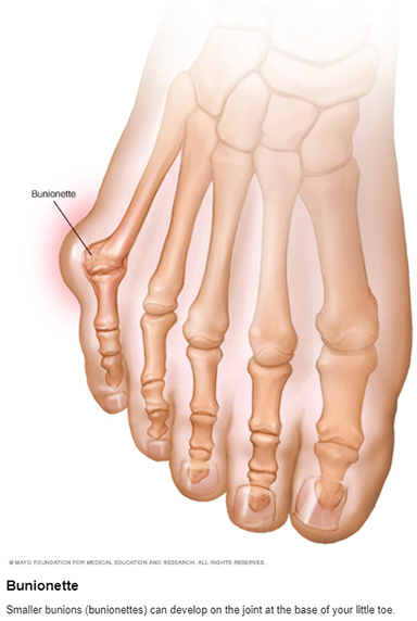 Bunionette